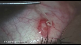 พยาธิในตา