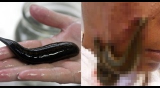 วิธีรักษาหลุมสิว