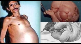 แฝดปรสิต