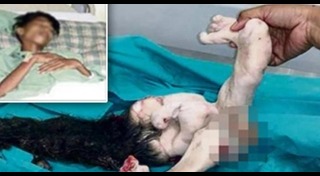 แฝดปรสิต