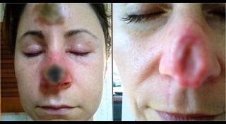 มะเร็งผิวหนัง