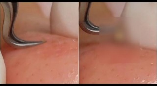 สิวอุดตัน