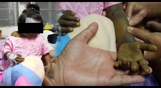 โรคตับแข็ง