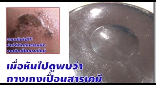 ผิวหนังอักเสบ