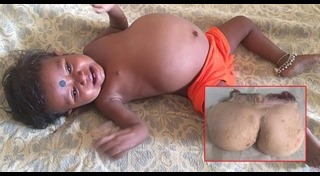 แฝดปรสิต