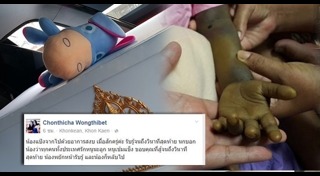 โรคตับแข็ง