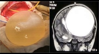 พยาธิในสมอง