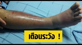 เส้นเลือดขอด