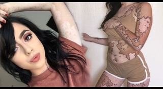 โรคด่างขาว