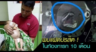 แฝดปรสิต