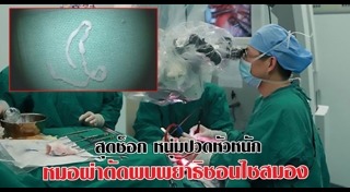 พยาธิในสมอง