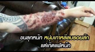 ลบรอยสัก