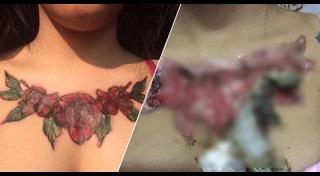 ลบรอยสัก