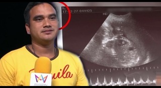 อัลตราซาวด์