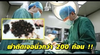 ผ่าตัดนิ่ว