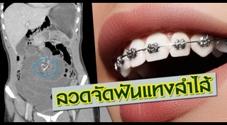 ลำไส้อักเสบ