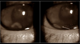 พยาธิในตา