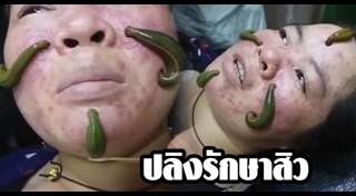 สิวอุดตัน