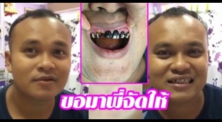 ขูดหินปูน