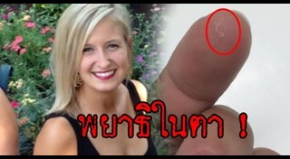 พยาธิในตา