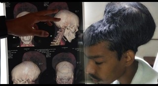 ผ่าตัดเนื้องอกในสมอง