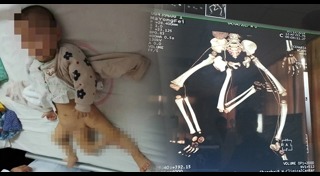 แฝดปรสิต