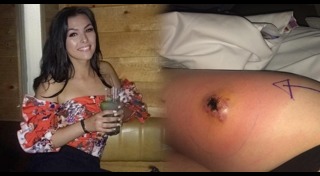 แมงมุมกัด