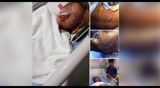 แพ้ยาขั้นรุนแรง