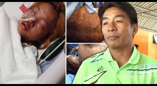 แพ้ยาขั้นรุนแรง