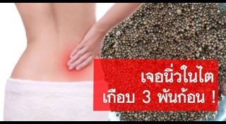 นิ่วในไต