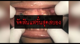 จัดฟันเถื่อน