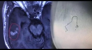 พยาธิในสมอง