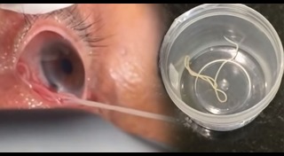 พยาธิในตา