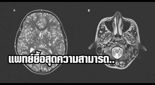 พยาธิในสมอง