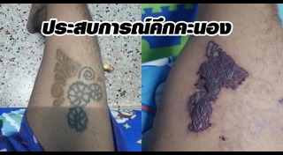 ลบรอยสัก