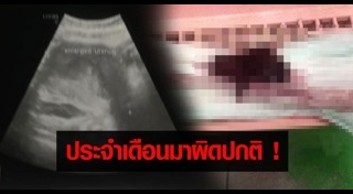 ประจำเดือนมาไม่ปกติ