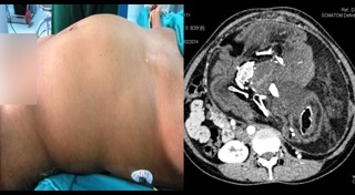 แฝดปรสิต