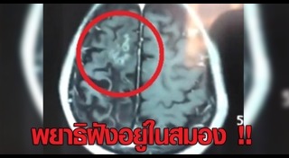 พยาธิในสมอง