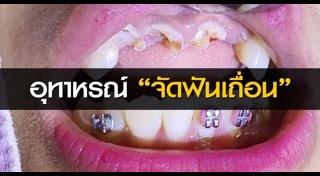 จัดฟันเถื่อน
