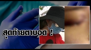 เสริมจมูก