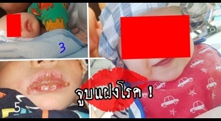 เริมที่ปาก