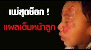 เด็กพิการ