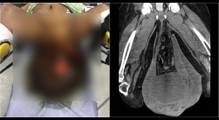 ไส้เลื่อน