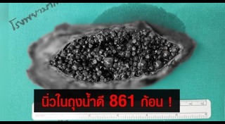 นิ่วในถุงน้ำดี