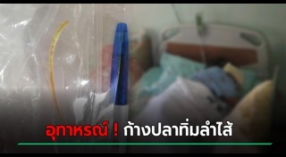 ก้างปลาติดคอ