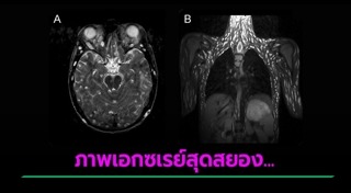 พยาธิในสมอง