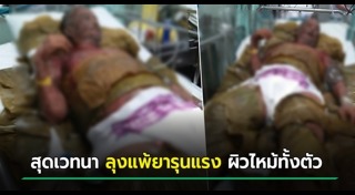 แพ้ยาขั้นรุนแรง