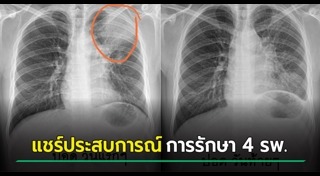 มะเร็งต่อมน้ำเหลือง