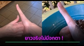 นิ้วผิดปกติ