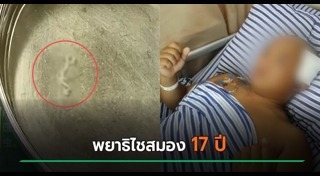 พยาธิไชสมอง